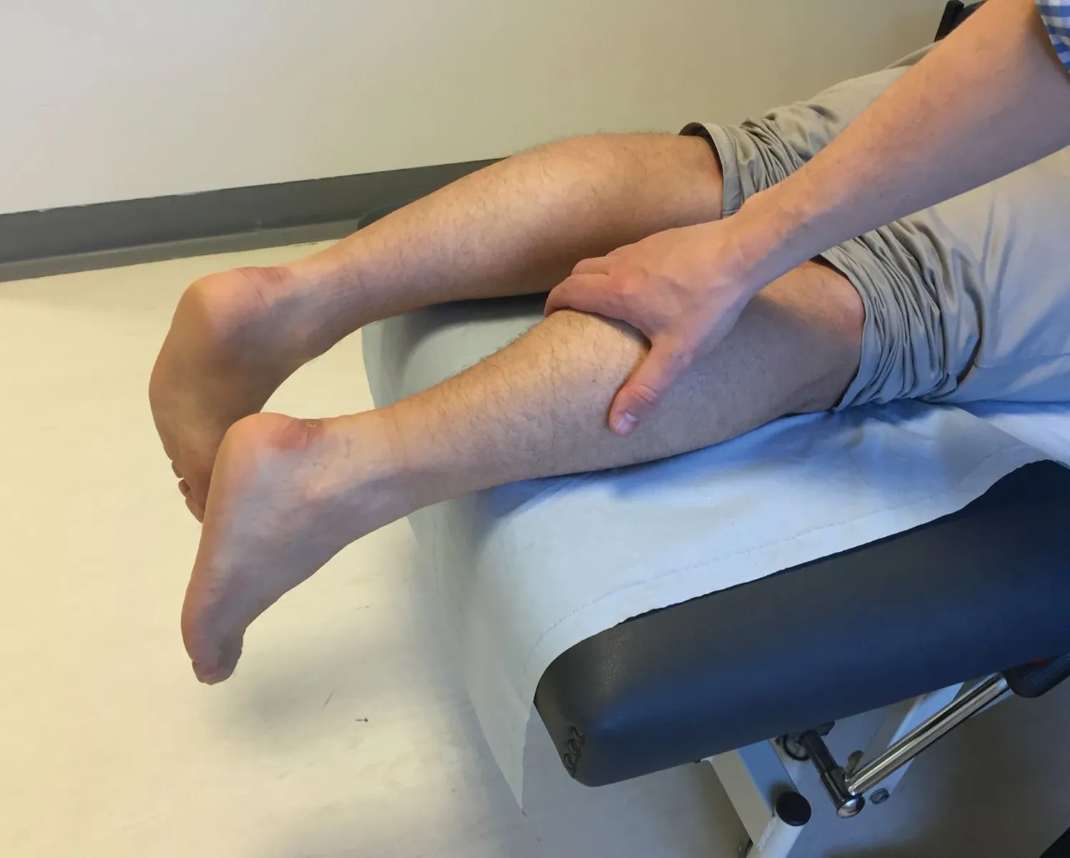 So You’ve Ruptured Your Achilles Tendon