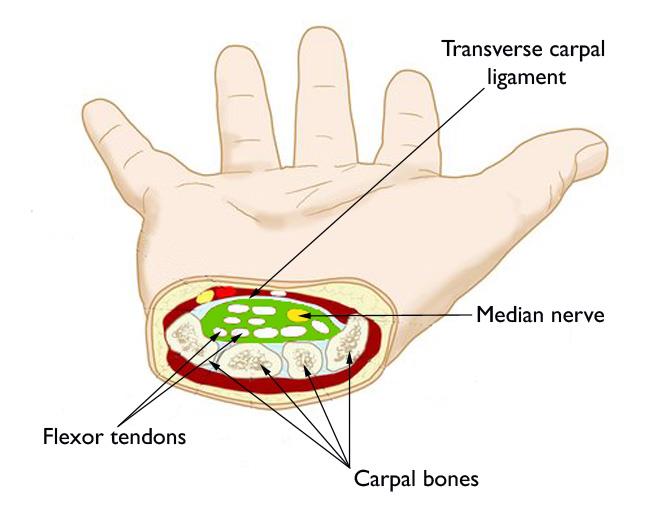 Preventing, treating Carpal Tunnel Syndrome
